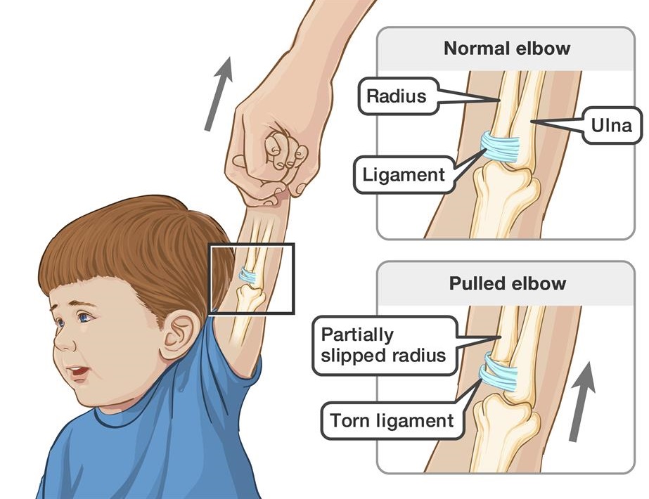 pulled-elbow-dr-megs-kids-health-guru